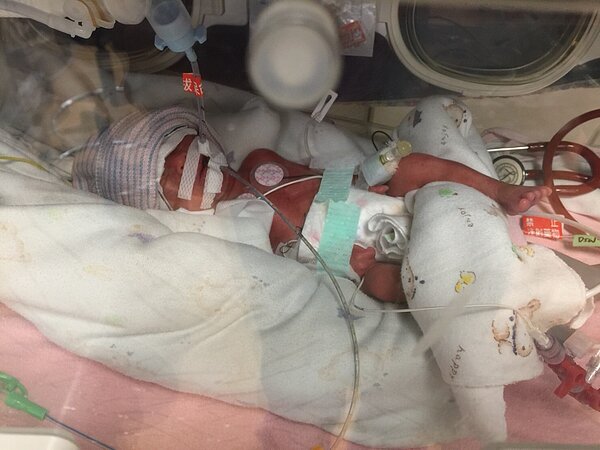 圖左:出生時全身插滿維生系統的娜娜。(好醫師新聞網)