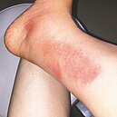 火蟻咬傷恐喪命　3步驟緊急處理