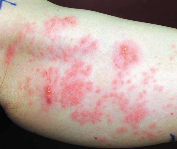 初期帶狀皰疹症狀不明顯，患者常誤以為是其他疾病。 圖／聯合報系資料照片