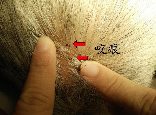 基隆張伯伯被龜殼花咬到頭,圖為張伯伯頭上的龜殼花咬痕。 圖/北榮提供