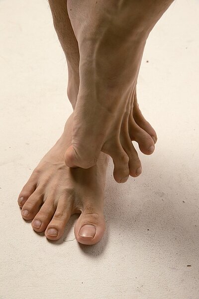 黴菌有許多種類,皮膚科門診最常見的致病菌是皮癬菌。肉眼看不見的皮癬菌喜歡生長在潮濕溫熱的環境,台灣的氣候很適合它增生,它的的菌絲在地上隨處飄,生活中到處都有,游泳池、健身房浴室地面特別多。圖/本報資料照片