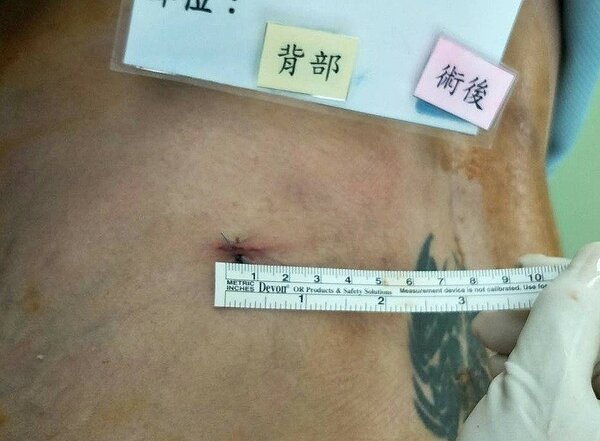 楊椒喬表示，新式脊椎內視鏡神經減壓手術可快速移除突出椎間盤，且傷口小於1公分，組織破壞和出血量少，讓病人術後盡早重回原本生活。記者蔡容喬／攝影
