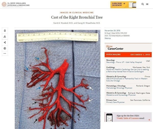 新英格蘭醫學期刊發表案例，一名加州男子因病劇咳，咳出右邊整個支氣管樹形狀的血塊。 圖／擷自新英格蘭醫學期刊網站