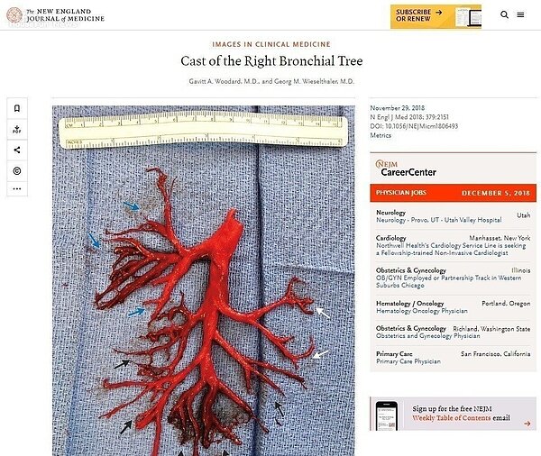 新英格蘭醫學期刊發表案例,一名加州男子因病劇咳,咳出右邊整個支氣管樹形狀的血塊。 圖/擷自新英格蘭醫學期刊網站