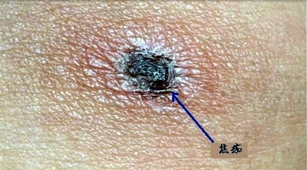 遭恙蟲叮咬發病會持續高燒、頭痛等症狀,之後皮膚出現紅色斑狀丘疹,叮咬處還有焦痂。圖/南投衛生局提供