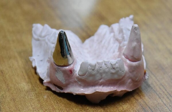 「團團」的牙套特別選用「鈦金屬」材質