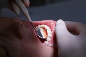 牙周病健保到底有沒有給付？　只有這4項健保沒付