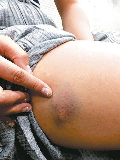 血小板低下紫斑症者身上常有不明瘀青。 圖/聯合報系資料照片