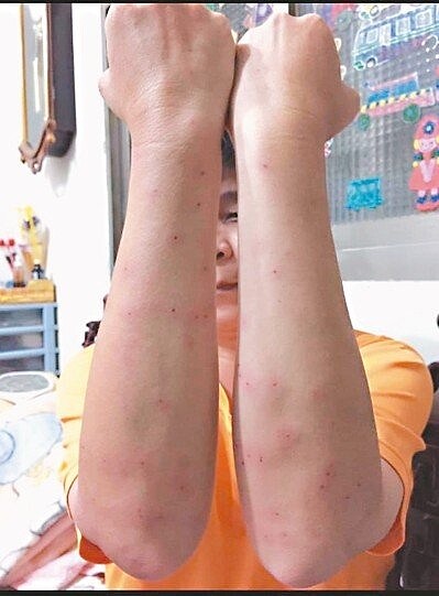 有人分享自己在公園釣魚兩小時,被小黑蚊叮咬,雙手手臂都是「紅豆冰」。圖/擷取自臉書社團「我是竹東人」