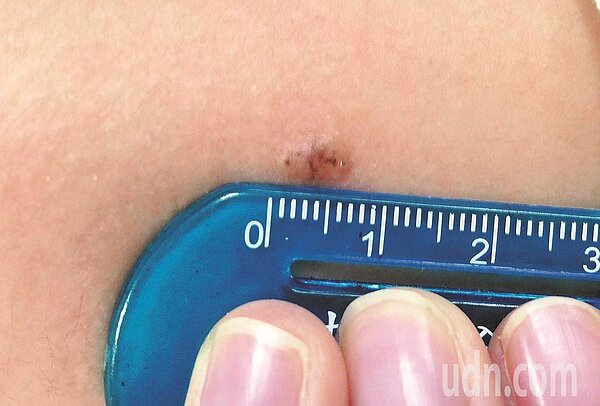 皮膚科醫師表示,皮膚上的痣出現變化,如出現黑色斑塊、不對稱、不同顏色、突起或大於0.6公分以上等情形,就有可能是皮膚癌,建議民眾趕緊求診。本報資料照片