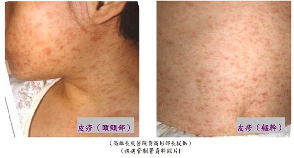 居住於桃園市龜山區的30歲男性,4月初期間曾至龜山區某店家用餐,疑似和新北林口確診個案於同一餐廳用餐,研判為用餐時遭麻疹確診個案感染。圖/衛生局提供