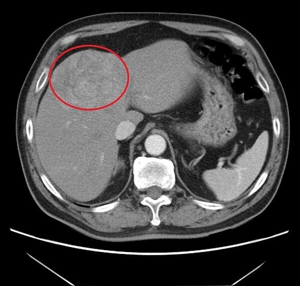 王姓病患因指數異常進一步檢查,發現一顆大於7公分的肝臟腫瘤(紅圈處)。圖/大千綜合醫院提供