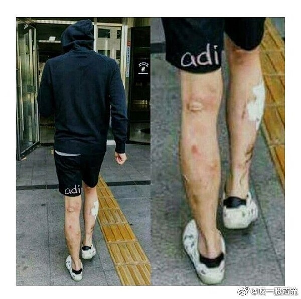 朴有天過去皮膚潰爛的照片被網友挖出。圖/摘自微博