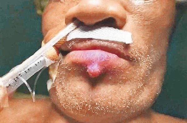 高雄一名60歲老翁,半年來因腰痠且小便帶有血絲,下嘴唇冒出一顆腫塊,求診才發現是罹患腎臟癌末期。圖/高醫泌尿部主治醫師錢祖明提供