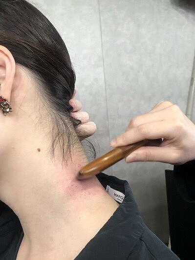 醫師指出,中醫觀點認為刮痧對中暑輕症有效,「意識清楚」是重點,若意識清楚,症狀多為偏輕型,透過刮痧來刺激皮膚表層,具活血、化瘀、行氣、補血等作用。本報資料照片