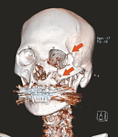 6旬婦低頭滑手機，不慎跌倒，造成顏面多處粉碎性骨折。 圖／台北馬偕醫院提供
