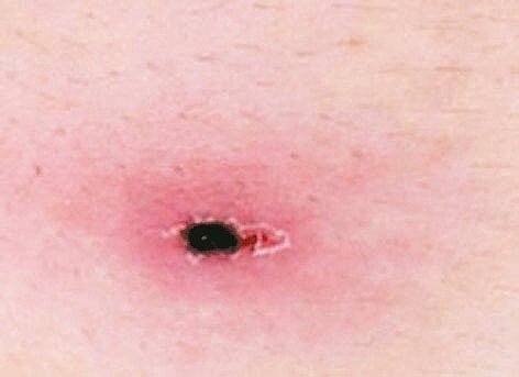 恙蟲病的潛伏期為6至21天，民眾可檢視恙蟎叮咬處是否出現無痛性的焦痂。 圖／台大醫院新竹分院提供