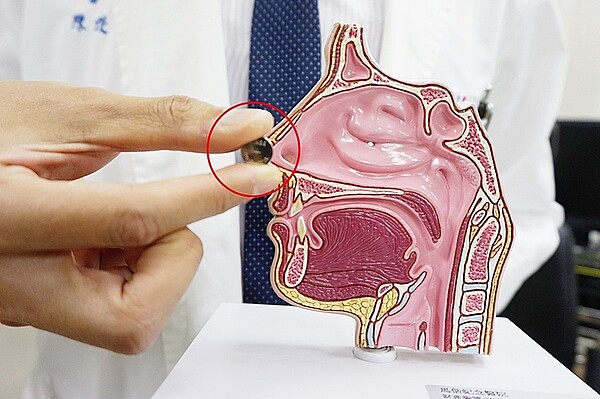 醫生提醒水銀電池是危險物品，家長需留意勿讓小孩放入耳、鼻、口中。圖／醫院提供