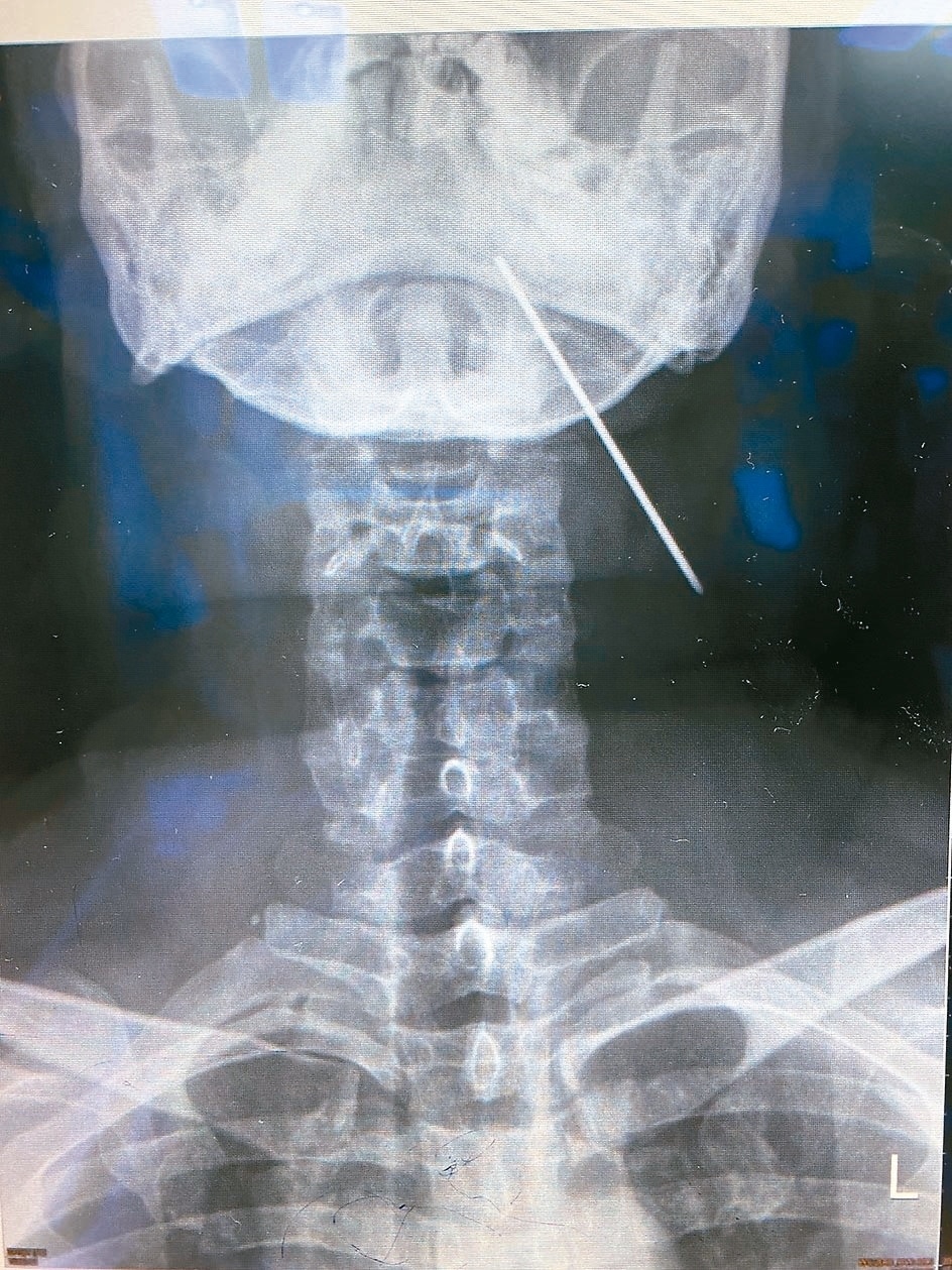 一名男快遞員因咳嗽就醫，經Ｘ光檢查發現他左頸靠近下巴的軟組織有一根8公分長的鋼釘。 記者王昭月／翻攝