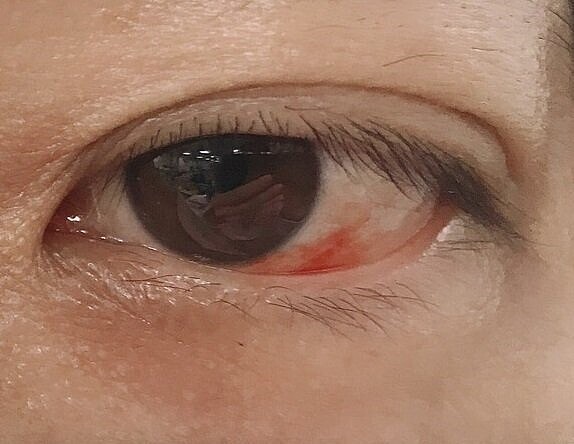 吳姓女子日前騎車遭冷風吹襲,造成眼睛微血管破裂。圖/童綜合醫院提供