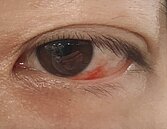 氣溫忽冷忽熱　女騎車吹冷風眼睛竟微血管破裂