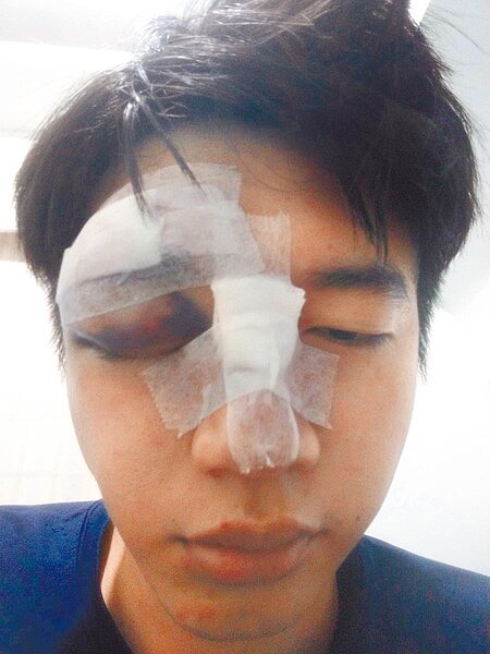 陳姓學生騎車摔成熊貓眼，與2名受害學生向市府提出國賠。（民眾提供／許家寧基隆傳真）