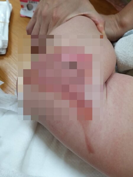 保母疑未注意水溫，造成7個月大女嬰臀部嚴重燙傷，臀腿紅腫、脫皮，全身4.5%二度燒燙傷。圖／女嬰家長提供