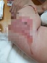 新竹托嬰中心熱水燙7月大女嬰　造成臀腿大面積脫皮