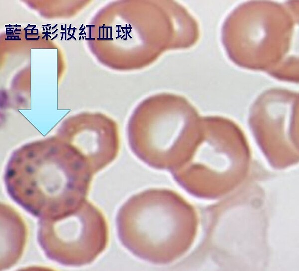 鉛中毒的患者可以在血液檢查中看到獨特的「藍色彩妝紅血球」。圖／取自網路