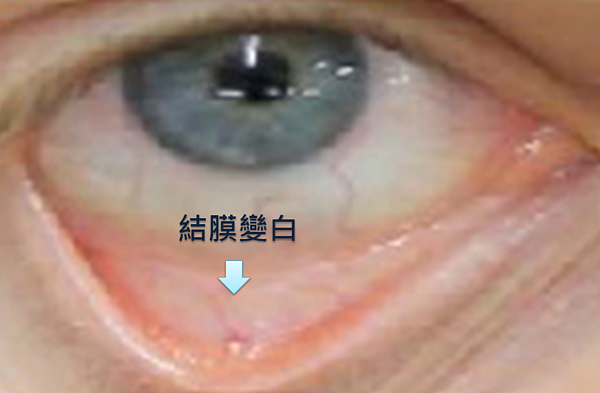 鉛中毒的患者結膜處會變白。圖/取自網路