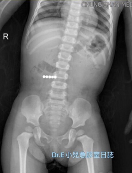 一歲男童誤吞有磁力的巴克球，X光下看到5小顆巴克球因吸力而在肚子裡排成一排。圖／取自謝宗學醫師臉書