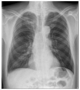 醫師洪盈盈說明，62歲上班族男子接受胸部X光檢查，未顯示肺癌。圖／洪盈盈提供