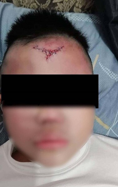 男童受傷後送醫後一共縫13針。圖/葉元之提供