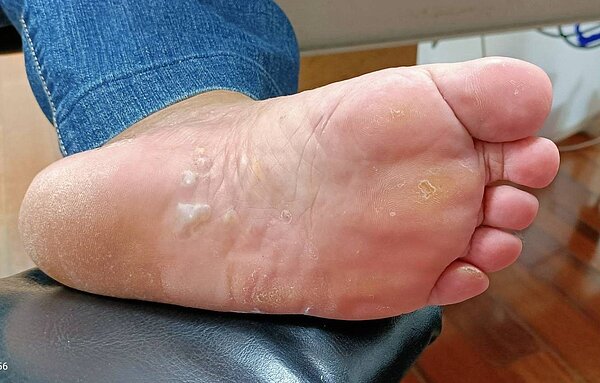 南投縣周姓婦人將暖暖包貼腳底,為防掉落還套襪固定,未料腳底竟被燙傷起水泡。圖/南投醫院提供