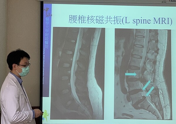 醫師楊宗熹指林姓病患腰椎椎間盤突出,造成急性下肢麻痛。圖/中山附醫提供