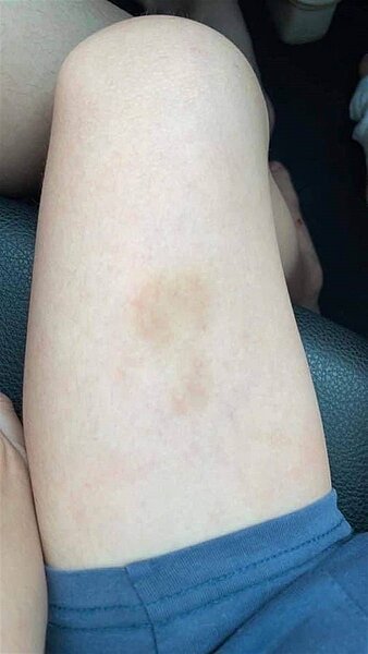 男童全身傷痕累累,大腿處也有明顯瘀青,至今回到母親身邊一個多月,仍常暗夜哭泣、做惡夢;讓母親心疼難過淚崩。(徐奕提供/謝瓊雲彰化傳真)