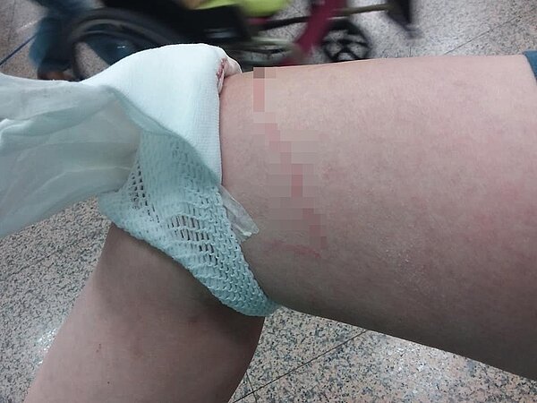 一名王姓女子提醒鄰居戴口罩,卻被對方連刺30刀,她從臉、頸部、眼睛周遭都是刀傷。圖/翻攝自爆料公社公開版