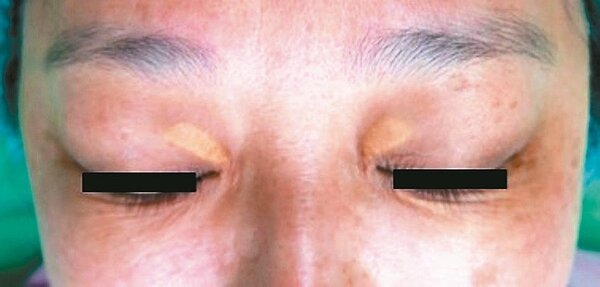 黃斑瘤通常好發40至50歲女性，可透過手術改善外觀。圖／李秉侖提供