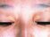眼皮冒黃斑瘤　多與高血脂有關