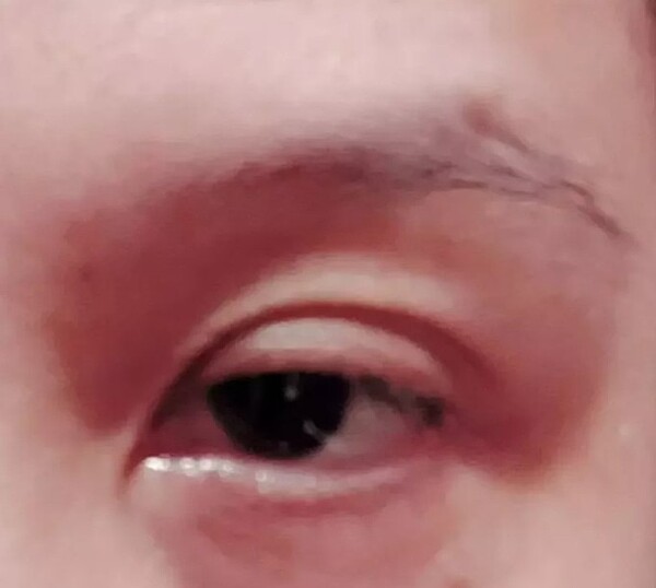 一名家庭主婦騎車買菜以為眼睛進沙不以為意,隔天痛如針刺,眼皮都腫脹。圖/聯合報