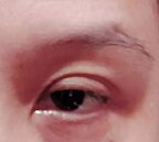 低溫乾燥+長時追劇　乾眼症病人增3成