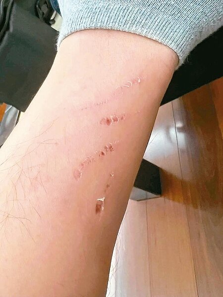 民眾表示,電扶梯瞬間失速,導致30人摔落,自己雖然穿著長褲,但還是被夾傷。圖/記者江婉儀翻攝