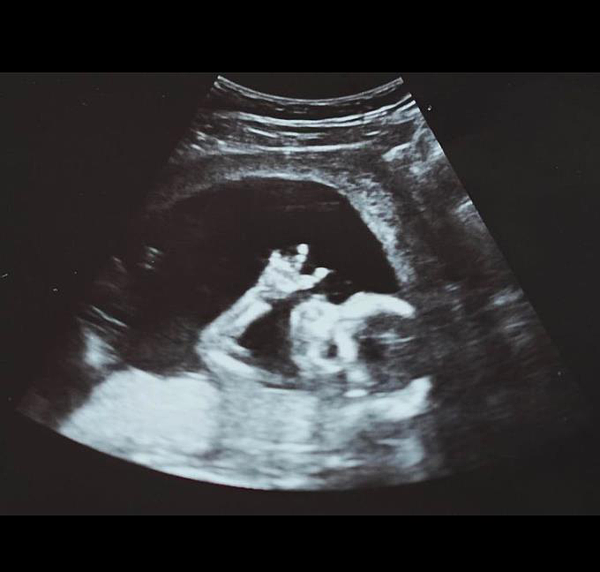 瘦子分享孩子超音波照片。圖／摘自IG