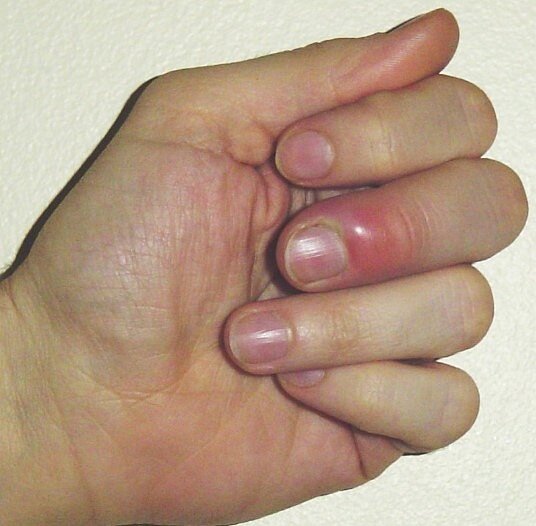 「戴口罩、勤洗手」是防範感染最基本有效的生活習慣,然而民眾在養成洗手習慣的同時,也有可能染上「慢性甲溝炎」的症狀。圖/翻攝自維基百科