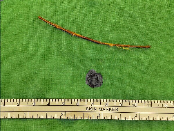 醫師張鈺棠研判這根9公分的樹枝像葉梗的構造,但通常超過5公分的異物難以通過胃部及幽門。(高雄醫學大學附設中和醫院提供/楊舒婷高雄傳真)