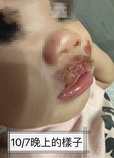 高市1歲女童家屬在臉書社團貼出女童疑在托兒所遭保母餵奶時,遭高溫奶水燙傷,嘴唇在事發隔天變成香腸嘴,還有點潰爛,令人看了心疼。圖/取自臉書社團「報廢公社」