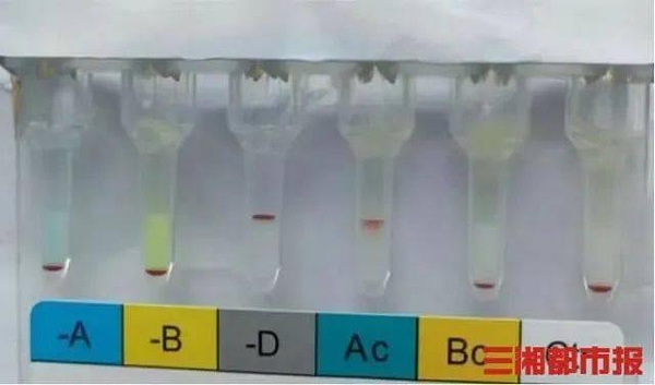 為確保准確性醫師又為其進行了血型基因檢測,根據結果,血清學為類孟買B型。(取材自三湘都市報)