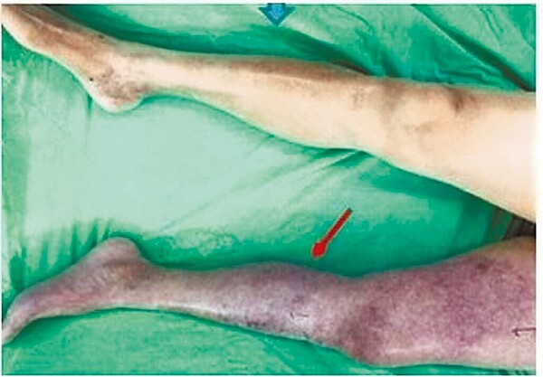 深部靜脈栓塞會導致患部腫脹疼痛,皮膚出現暗沉以及紫斑的現象,若沒有即早治療,恐會面臨截肢手術,不截肢則會死亡。(高雄市立民生醫院提供/楊舒婷高雄傳真)