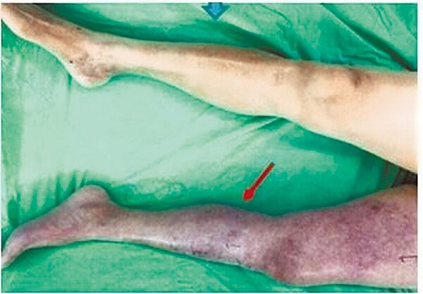 深部靜脈栓塞會導致患部腫脹疼痛，皮膚出現暗沉以及紫斑的現象，若沒有即早治療，恐會面臨截肢手術，不截肢則會死亡。（高雄市立民生醫院提供／楊舒婷高雄傳真）