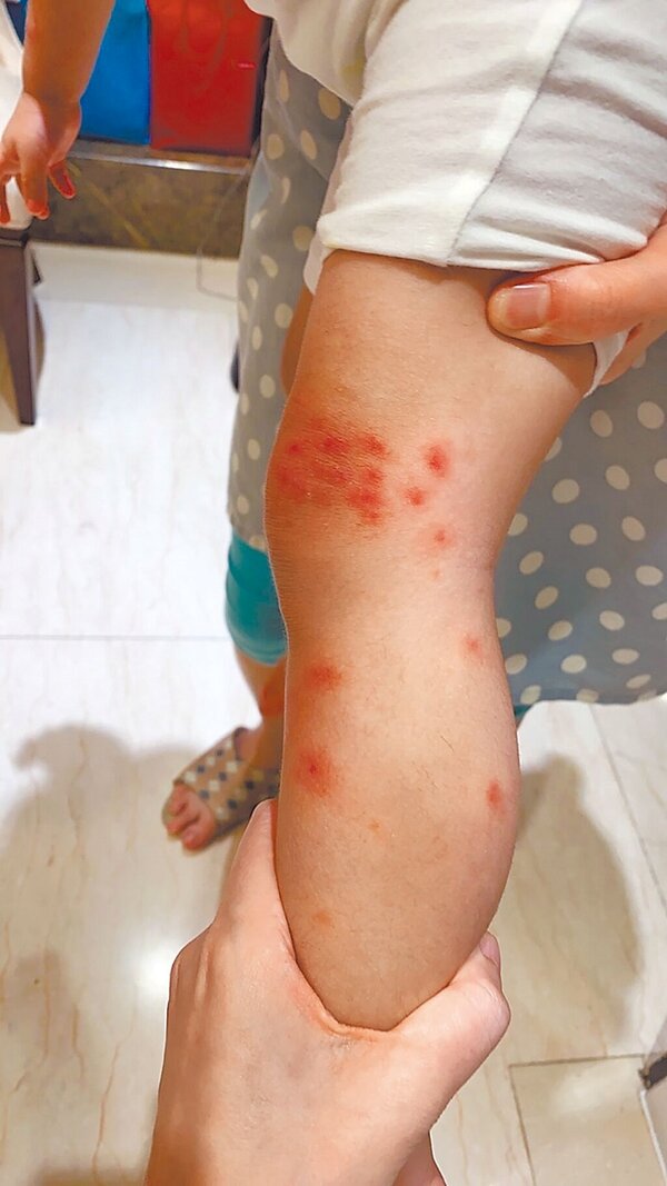 3歲幼童到高美館遊玩，竟被小黑蚊叮了上百個包。（高雄市議員陳美雅提供／柯宗緯高雄傳真）